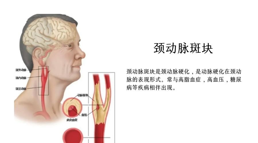 易爱科普｜成年人1/3都存在的颈动脉斑块究竟是什么？
