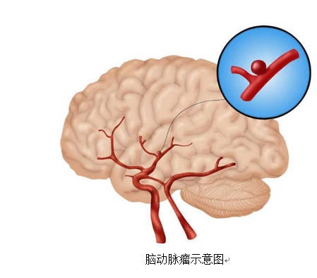 藏于颅内的定时炸弹——脑动脉瘤
