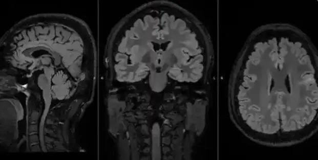 从“开环刺激”到“闭环响应”——甘肃首例脑机接口手术完成，引领神经调控新范式